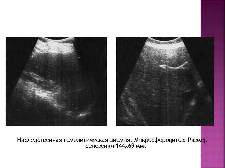 Наследственная гемолитическая анемия. Микросфероцитоз. Размер селезенки 144 х69 мм. 