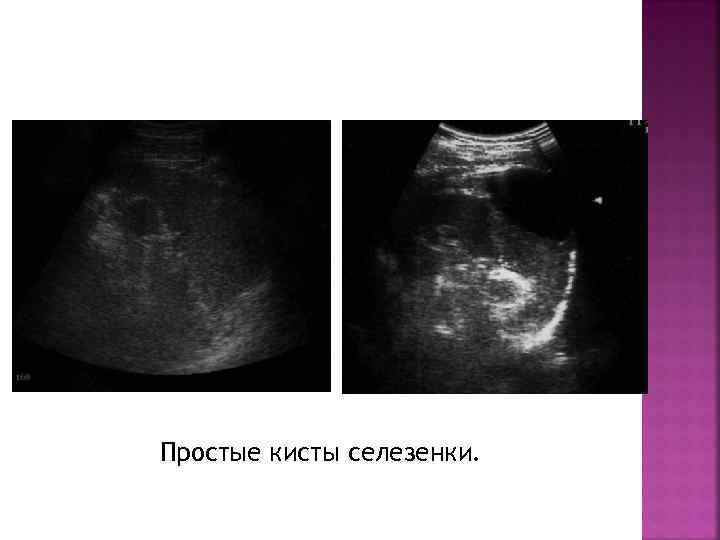 Простые кисты селезенки. 