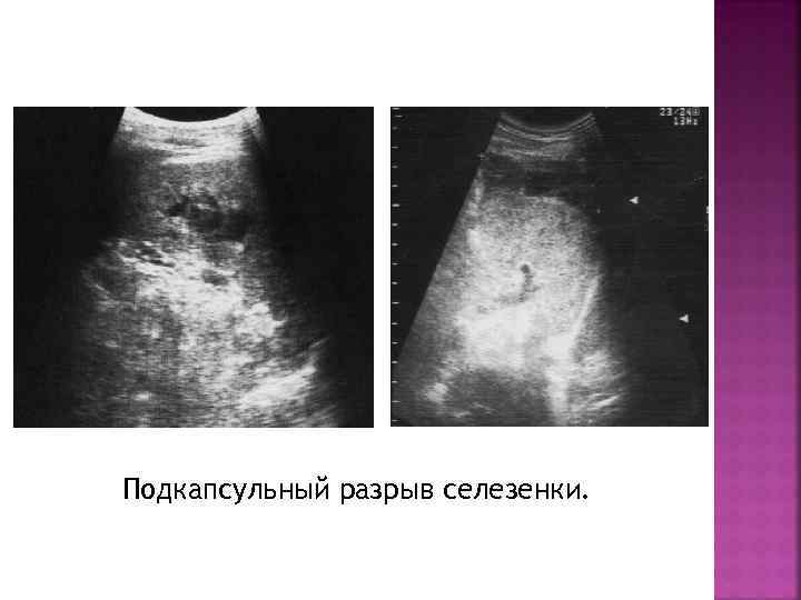 Подкапсульный разрыв селезенки. 