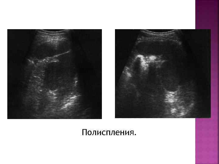 Полиспления. 
