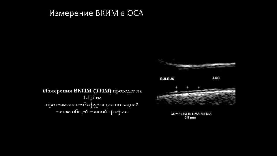 Измерение ВКИМ в ОСА Измерения ВКИМ (ТИМ) проводят на 1 -1, 5 см проксимальнее