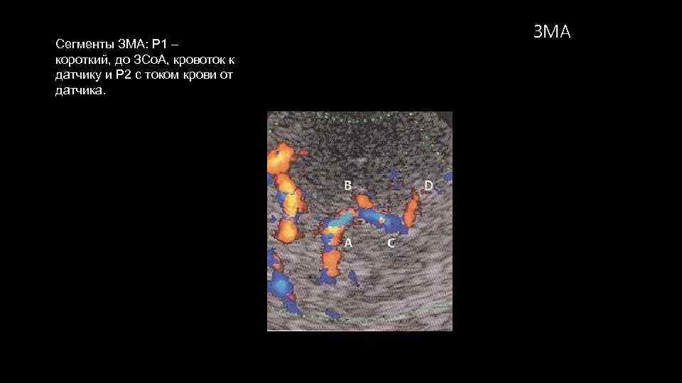 Сегменты ЗМА: Р 1 – короткий, до ЗСо. А, кровоток к датчику и Р