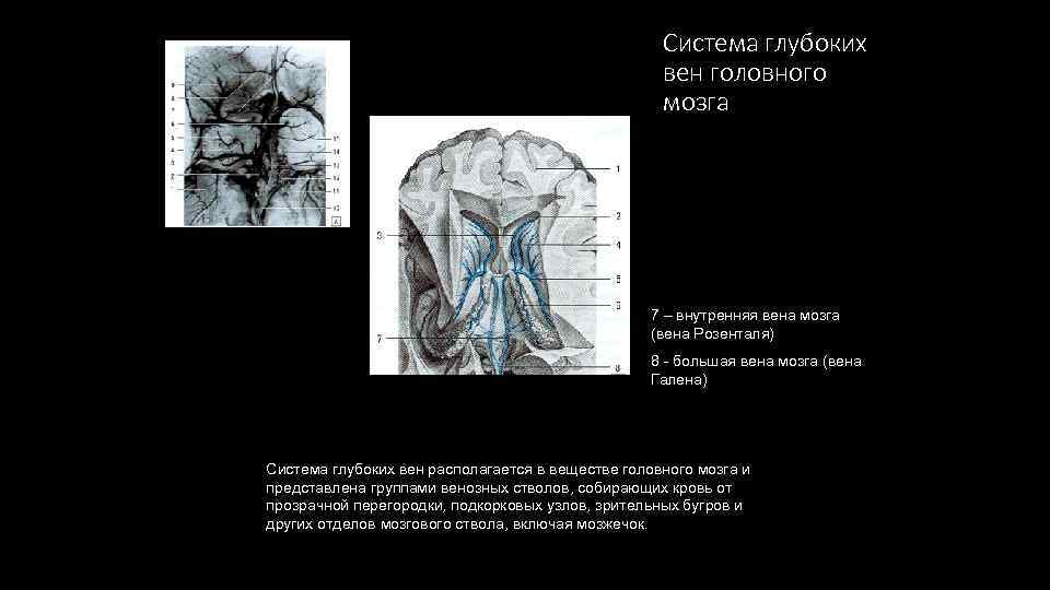 Вена галена. Вена Розенталя анатомия на УЗИ. Вены ствола головного мозга. Глубокие вены мозга Розенталя.