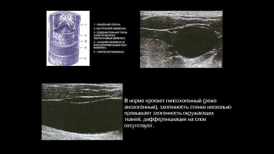1 – ВЕНОЗНЫЙ КЛАПАН 2 –ВНУТРЕННЯЯ ОБОЛОЧКА 3 - СОЕДИНИТЕЛЬНАЯ ТКАНЬ (ЭЛАСТИЧЕСКИЕ И КОЛЛАГЕНОВЫЕ
