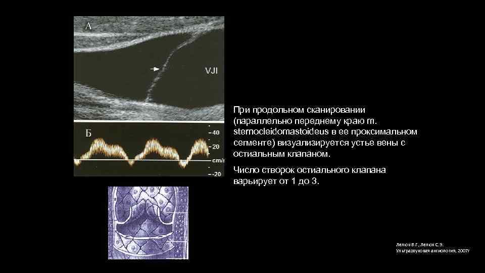 При продольном сканировании (параллельно переднему краю m. sternocleidomastoideus в ее проксимальном сегменте) визуализируется устье