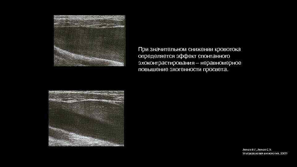 При значительном снижении кровотока определяется эффект спонтанного эхоконтрастирования – неравномерное повышение эхогенности просвета. Лелюк