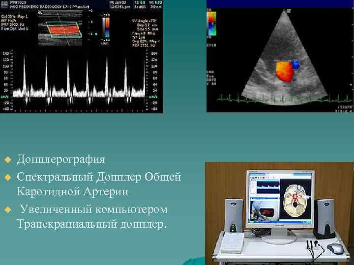 u u u Допплерография Спектральный Допплер Общей Каротидной Артерии Увеличенный компьютером Транскраниальный допплер. 