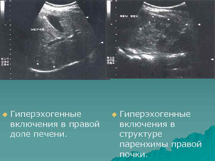 u Гиперэхогенные включения в правой доле печени. u Гиперэхогенные включения в структуре паренхимы правой