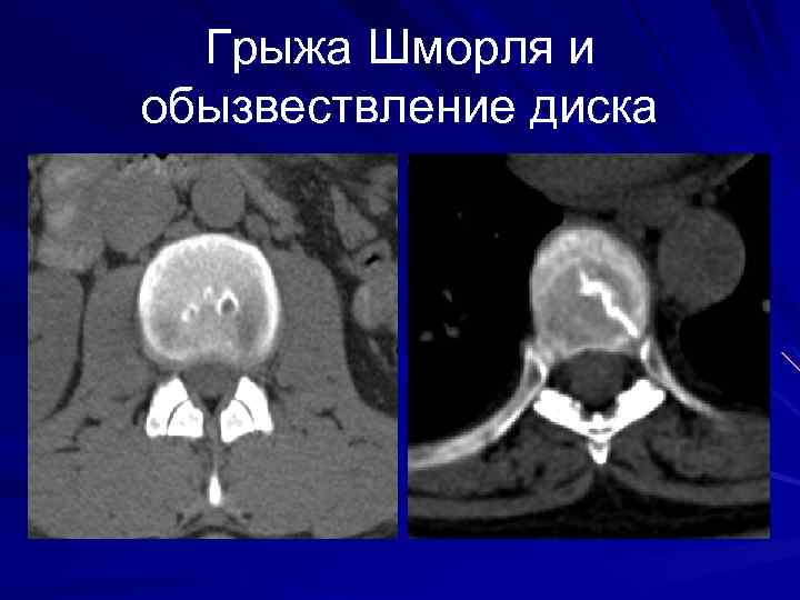 Грыжа Шморля и обызвествление диска 