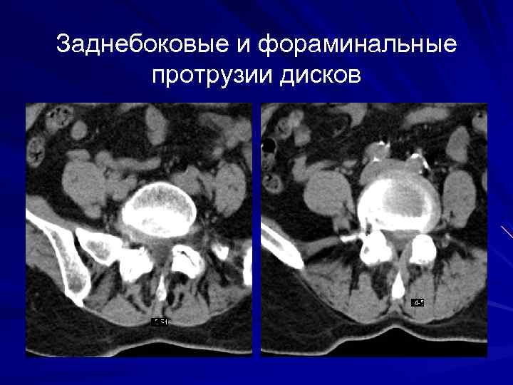 Заднебоковые и фораминальные протрузии дисков 