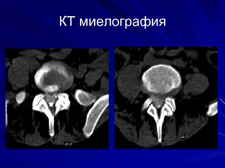 КТ миелография 