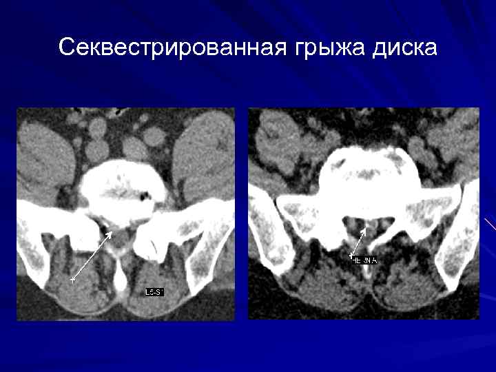 Секвестрированная грыжа диска 