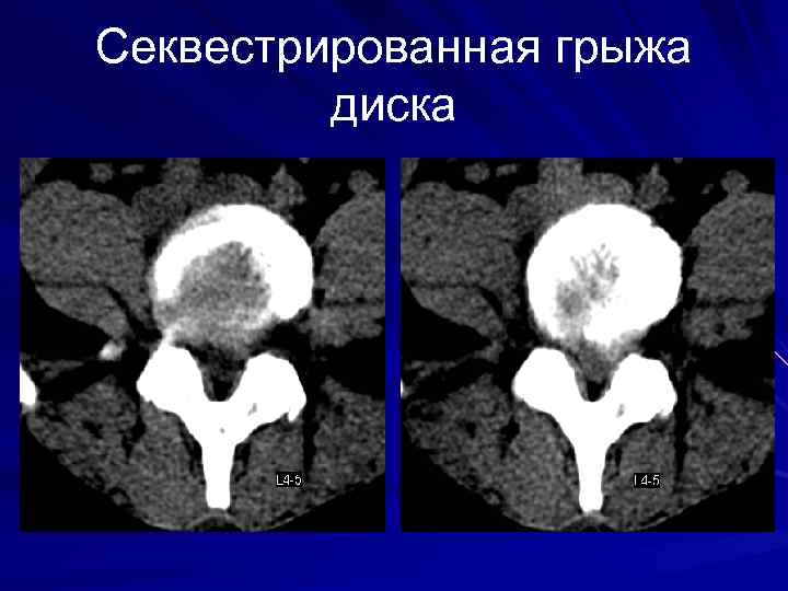 Секвестрированная грыжа диска 