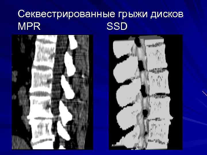 Секвестрированные грыжи дисков MPR SSD 