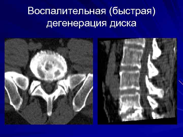 Воспалительная (быстрая) дегенерация диска 