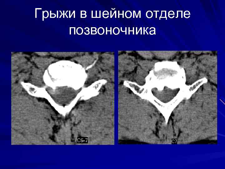 Грыжи в шейном отделе позвоночника 