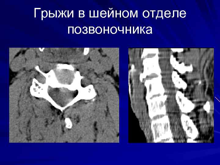Грыжи в шейном отделе позвоночника 