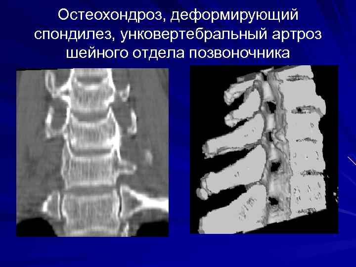 Остеохондроз, деформирующий спондилез, унковертебральный артроз шейного отдела позвоночника 