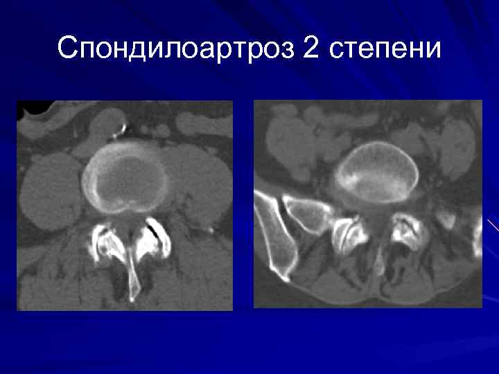 Спондилоартроз 2 степени 