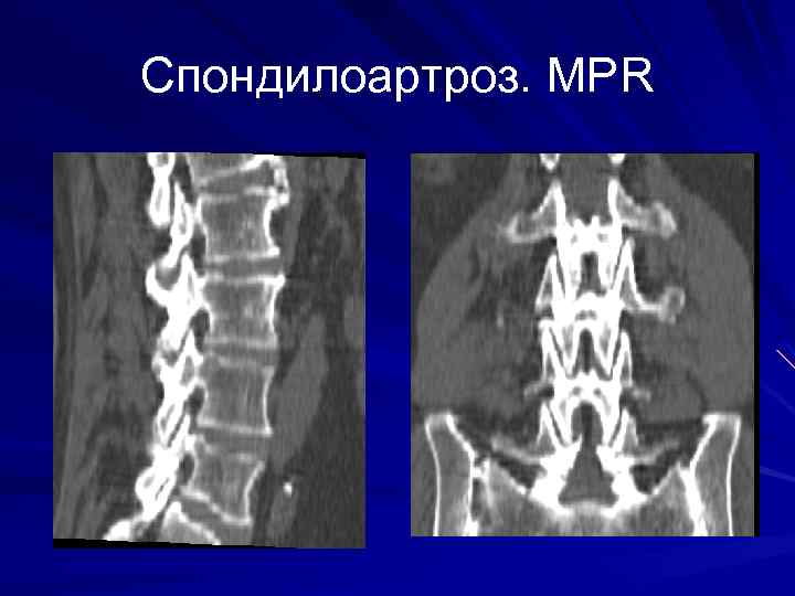 Спондилоартроз. MPR 