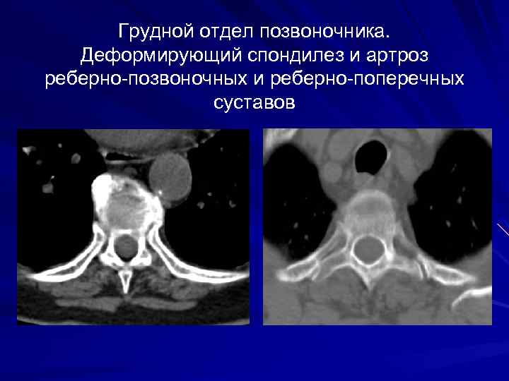 Грудной отдел позвоночника. Деформирующий спондилез и артроз реберно-позвоночных и реберно-поперечных суставов 