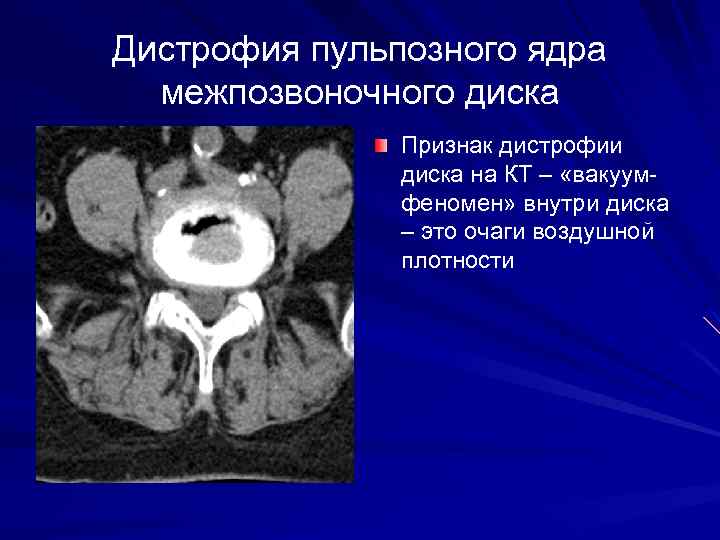 Дистрофия пульпозного ядра межпозвоночного диска Признак дистрофии диска на КТ – «вакуумфеномен» внутри диска