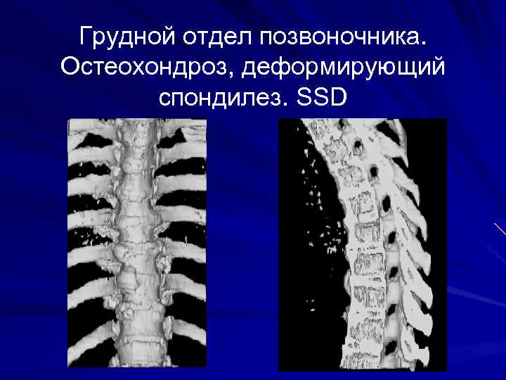 Грудной отдел позвоночника. Остеохондроз, деформирующий спондилез. SSD 
