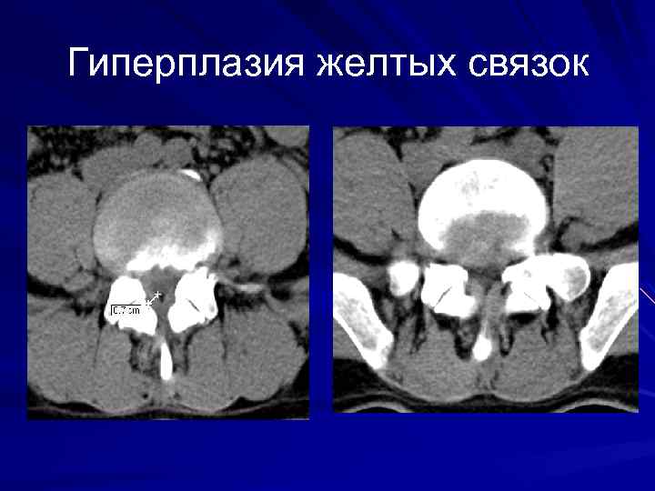 Гиперплазия желтых связок 