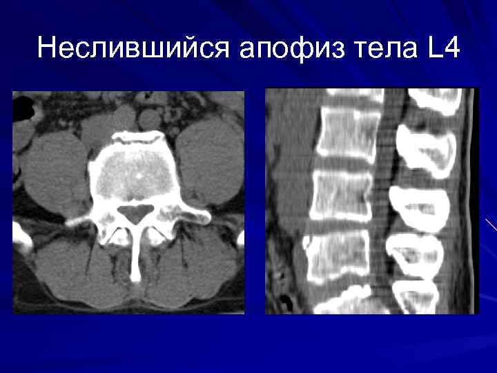 Неслившийся апофиз тела L 4 