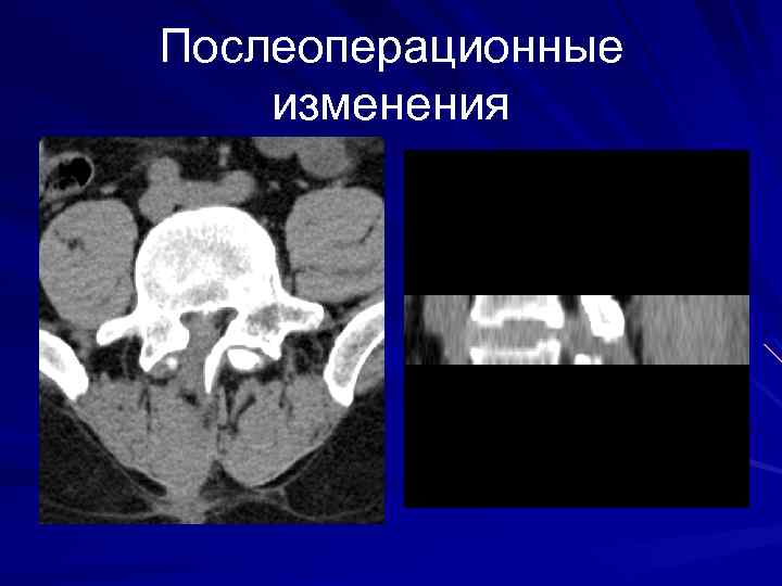 Послеоперационные изменения 