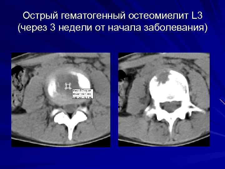Острый гематогенный остеомиелит L 3 (через 3 недели от начала заболевания) 