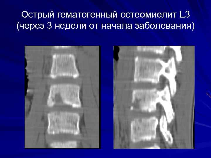 Острый гематогенный остеомиелит L 3 (через 3 недели от начала заболевания) 