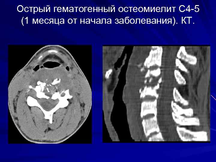 Острый гематогенный остеомиелит С 4 -5 (1 месяца от начала заболевания). КТ. 