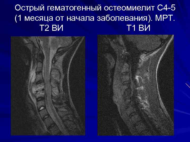 Острый гематогенный остеомиелит С 4 -5 (1 месяца от начала заболевания). МРТ. Т 2