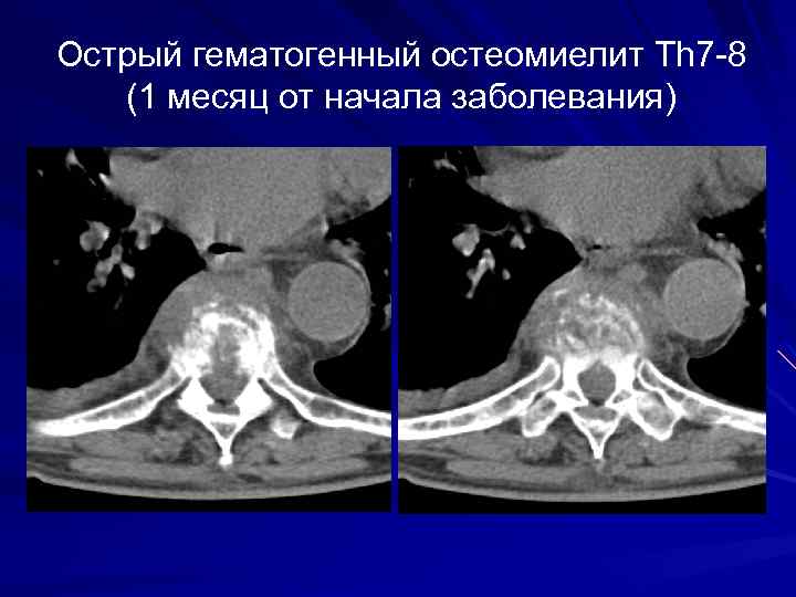 Острый гематогенный остеомиелит Th 7 -8 (1 месяц от начала заболевания) 