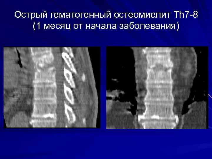 Острый гематогенный остеомиелит Th 7 -8 (1 месяц от начала заболевания) 