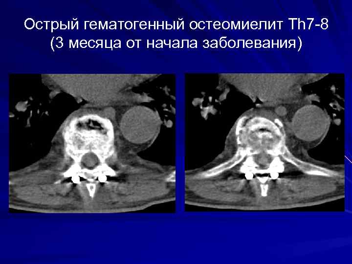 Острый гематогенный остеомиелит Th 7 -8 (3 месяца от начала заболевания) 