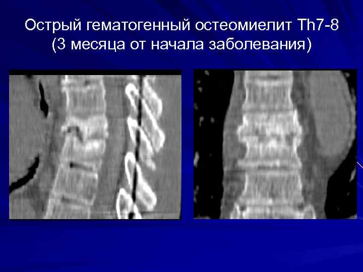 Острый гематогенный остеомиелит Th 7 -8 (3 месяца от начала заболевания) 
