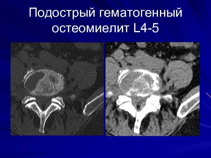 Подострый гематогенный остеомиелит L 4 -5 