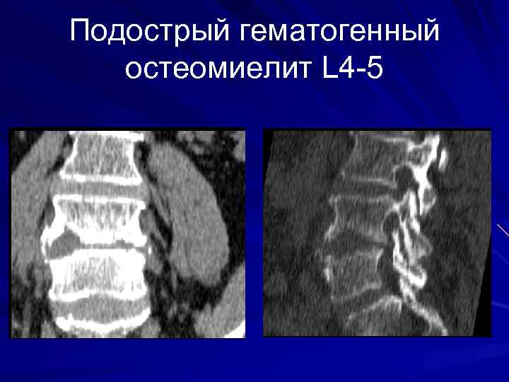 Подострый гематогенный остеомиелит L 4 -5 