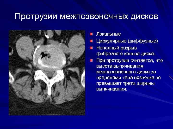 Протрузии межпозвоночных дисков Локальные Циркулярные (диффузные) Неполный разрыв фиброзного кольца диска. При протрузии считается,