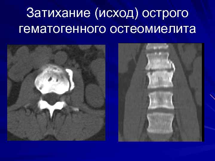 Затихание (исход) острого гематогенного остеомиелита 