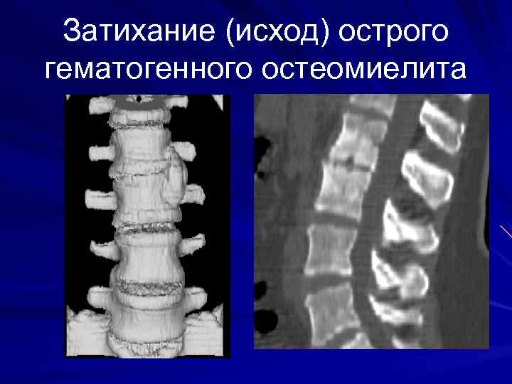 Затихание (исход) острого гематогенного остеомиелита 