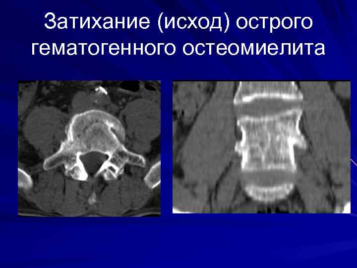 Затихание (исход) острого гематогенного остеомиелита 
