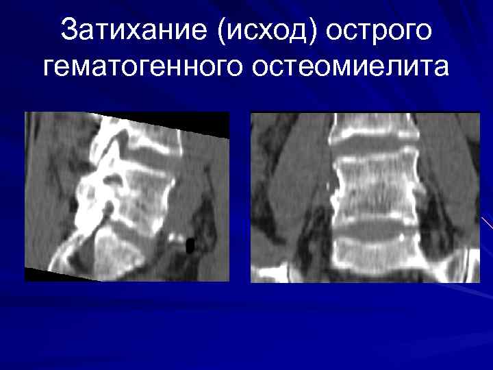 Затихание (исход) острого гематогенного остеомиелита 