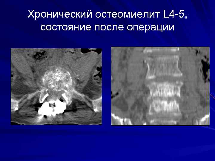 Хронический остеомиелит L 4 -5, состояние после операции 
