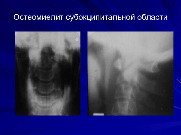 Остеомиелит субокципитальной области 