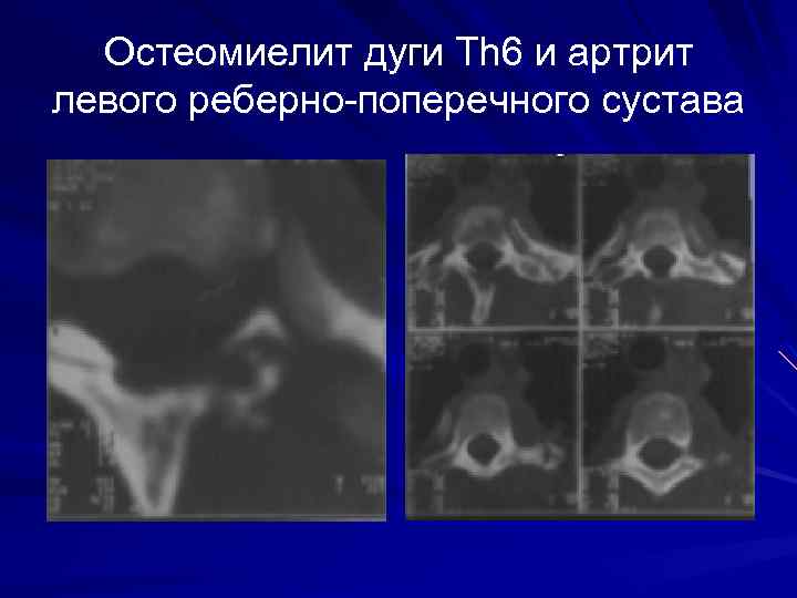 Остеомиелит дуги Th 6 и артрит левого реберно-поперечного сустава 