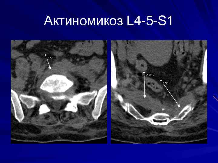 Актиномикоз L 4 -5 -S 1 