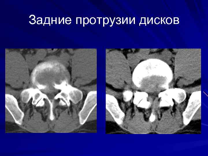 Задние протрузии дисков 